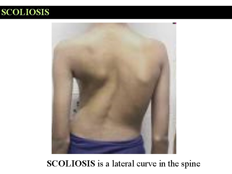 SCOLIOSIS is a lateral curve in the spine 