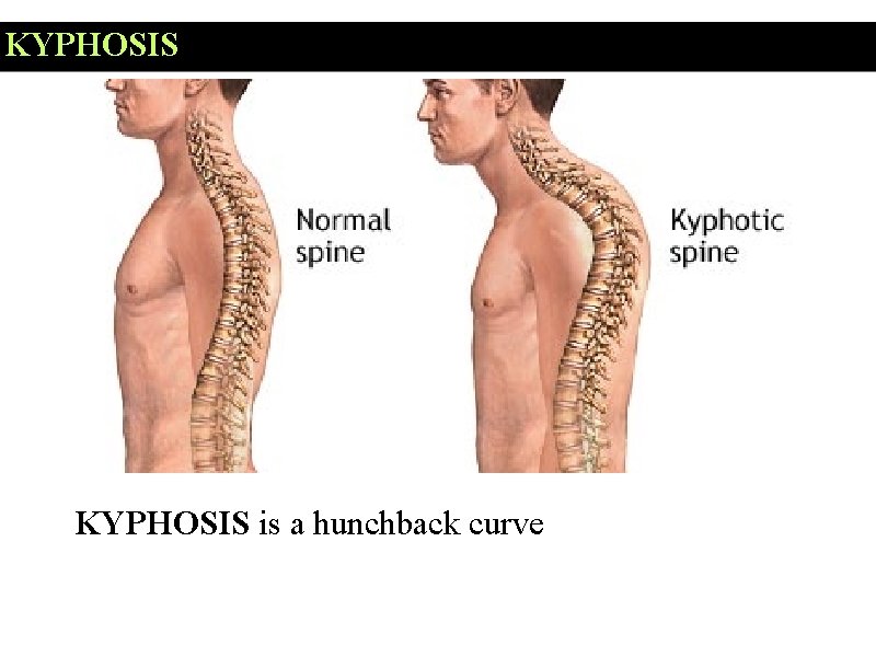 KYPHOSIS is a hunchback curve 