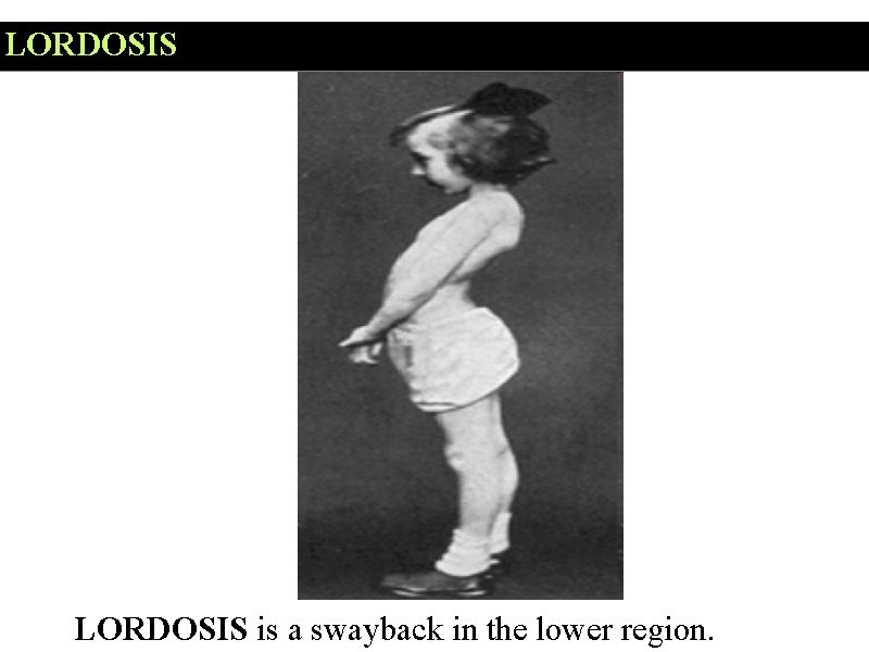 LORDOSIS is a swayback in the lower region. 