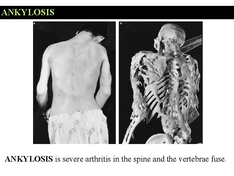 ANKYLOSIS is severe arthritis in the spine and the vertebrae fuse. 