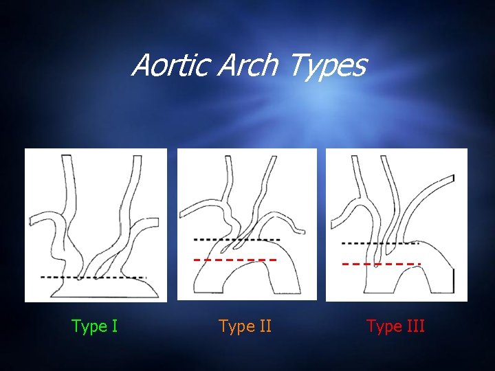 Aortic Arch Types Type III 