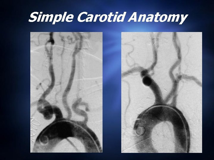 Simple Carotid Anatomy 