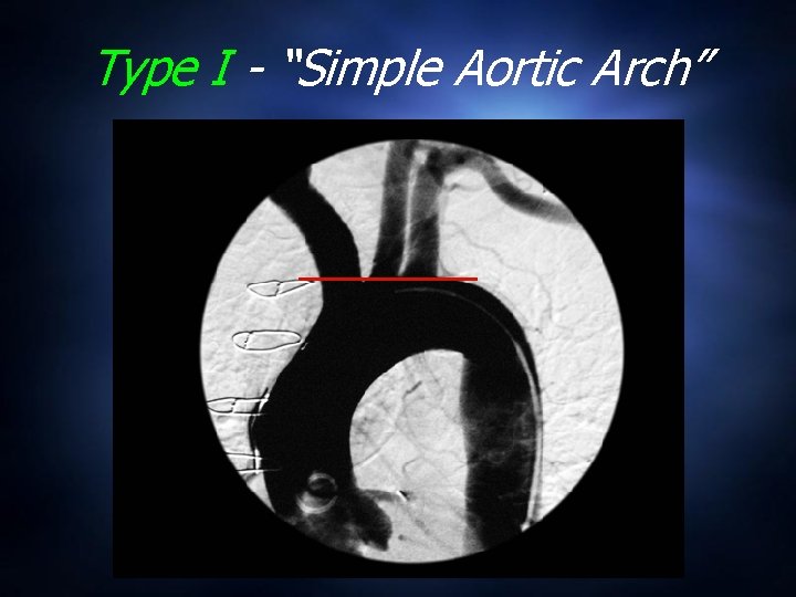 Type I - “Simple Aortic Arch” 