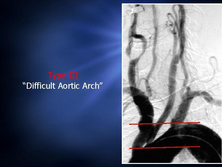 Type III “Difficult Aortic Arch” 