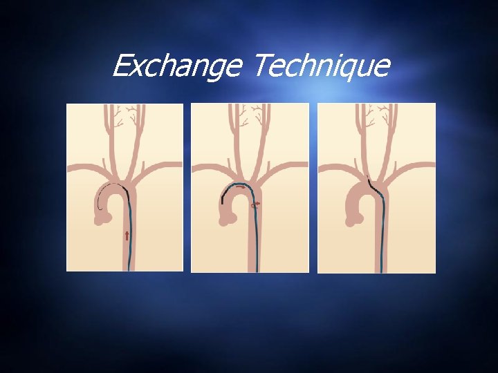 Exchange Technique 