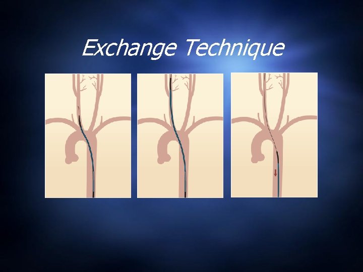 Exchange Technique 