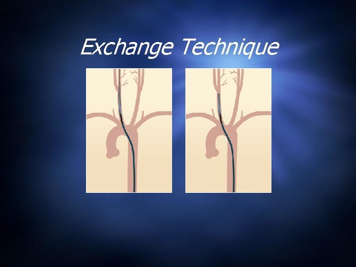 Exchange Technique 