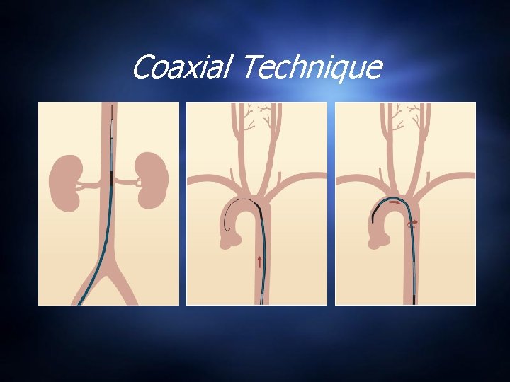 Coaxial Technique 