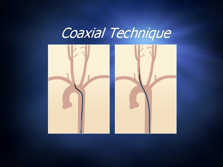 Coaxial Technique 