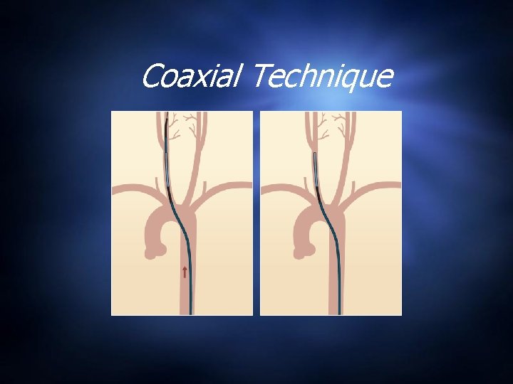 Coaxial Technique 