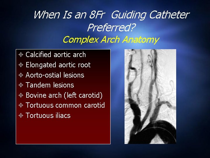 When Is an 8 Fr Guiding Catheter Preferred? Complex Arch Anatomy Calcified aortic arch