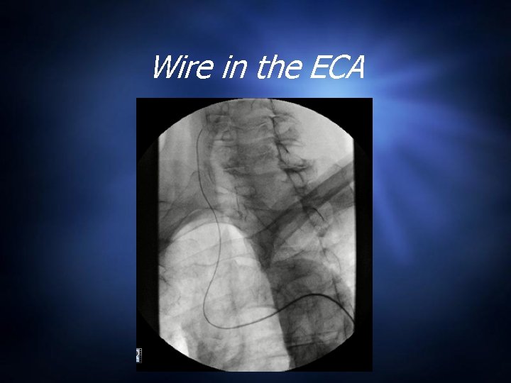 Wire in the ECA 