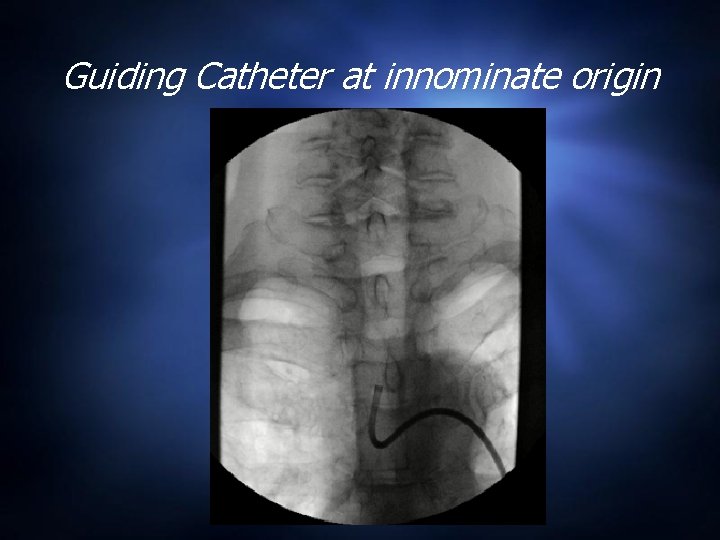 Guiding Catheter at innominate origin 