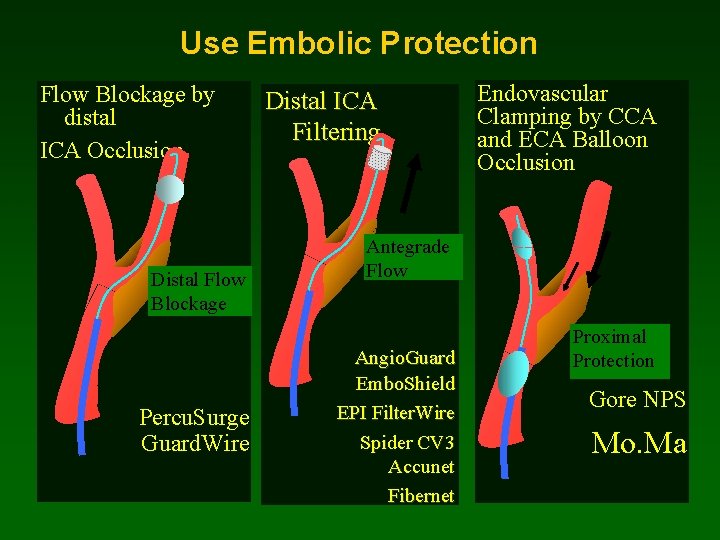 Use Embolic Protection Flow Blockage by distal ICA Occlusion Distal Flow Blockage Percu. Surge