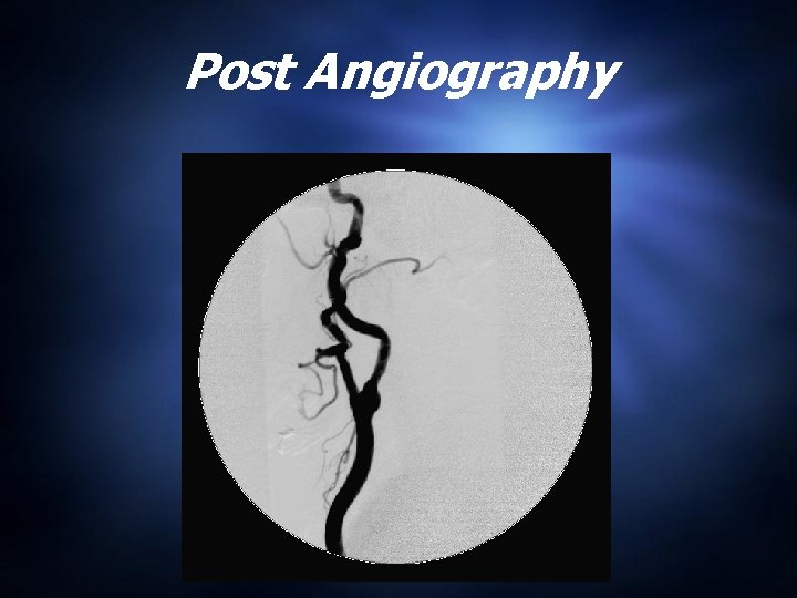 Post Angiography 