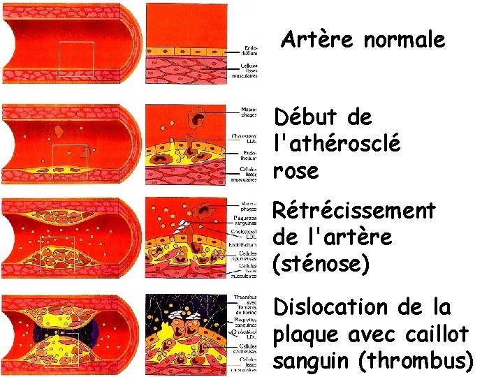 Artère normale Début de l'athérosclé rose Rétrécissement de l'artère (sténose) Dislocation de la plaque