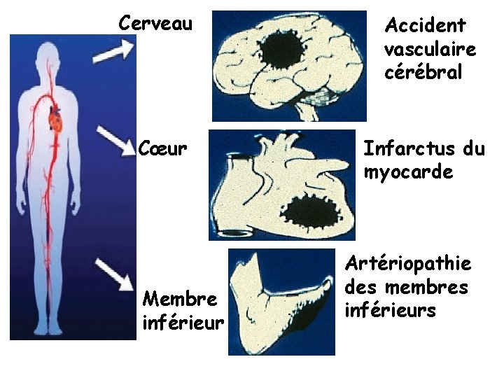 Cerveau Cœur Membre inférieur Accident vasculaire cérébral Infarctus du myocarde Artériopathie des membres inférieurs