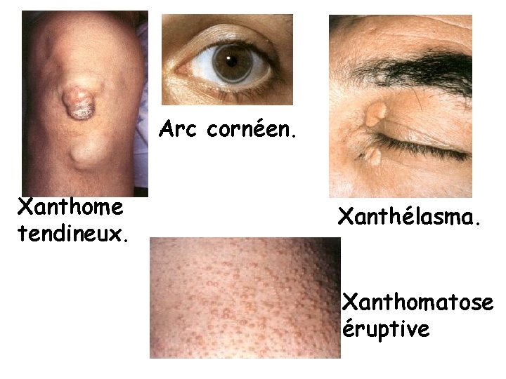 Arc cornéen. Xanthome tendineux. Xanthélasma. Xanthomatose éruptive 