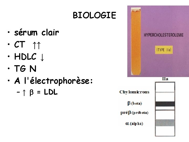 BIOLOGIE • • • sérum clair CT ↑↑ HDLC ↓ TG N A l'électrophorèse: