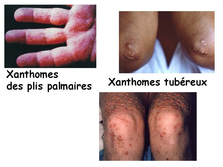 Xanthomes des plis palmaires Xanthomes tubéreux 