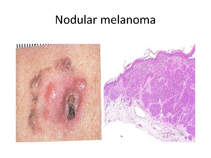 Nodular melanoma 