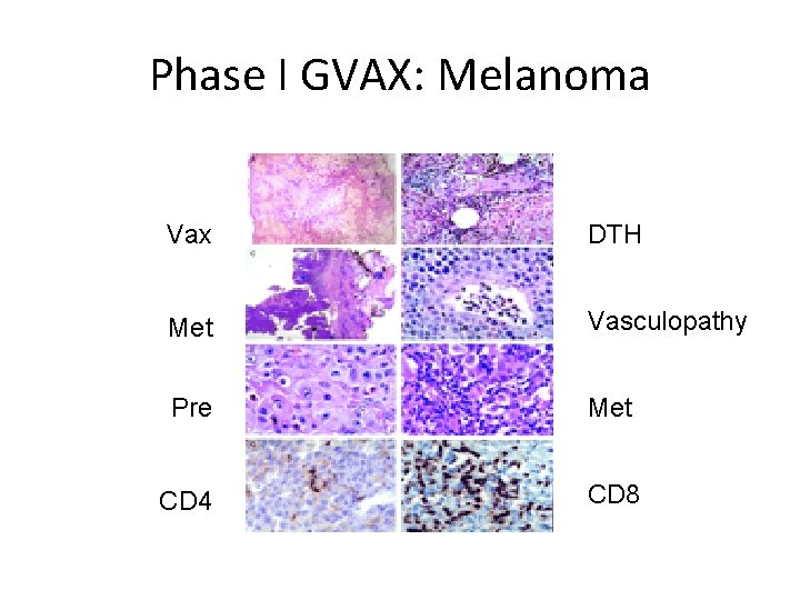 Phase I GVAX: Melanoma Vax DTH Met Vasculopathy Pre Met CD 4 CD 8