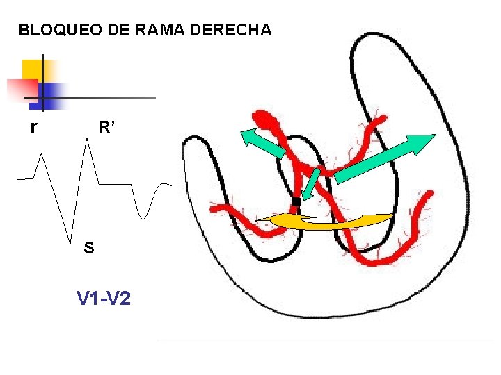 BLOQUEO DE RAMA DERECHA r R’ S V 1 -V 2 