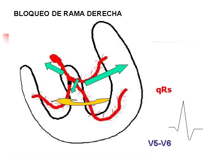 BLOQUEO DE RAMA DERECHA q. Rs V 5 -V 6 