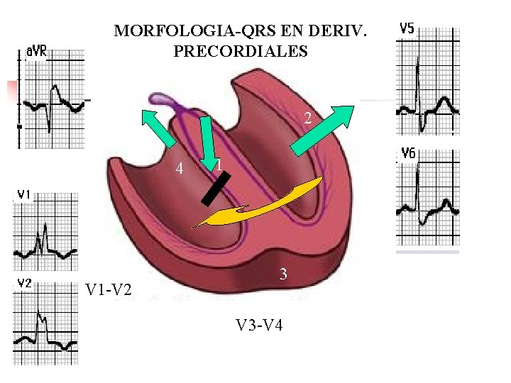 MORFOLOGIA-QRS EN DERIV. PRECORDIALES 2 4 1 V 5 -V 6 V 1 -V