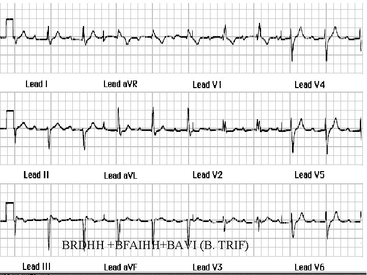 BRDHH +BFAIHH+BAVI (B. TRIF) 