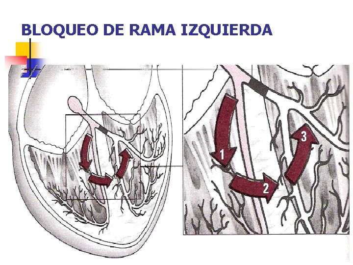 BLOQUEO DE RAMA IZQUIERDA 