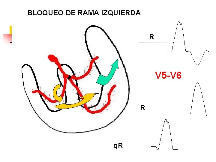 BLOQUEO DE RAMA IZQUIERDA R V 5 -V 6 R q. R 