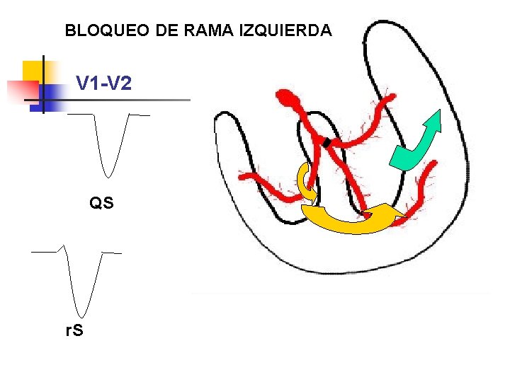 BLOQUEO DE RAMA IZQUIERDA V 1 -V 2 QS r. S 