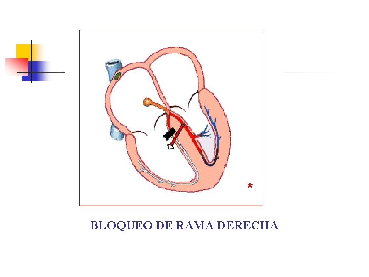 BLOQUEO DE RAMA DERECHA 