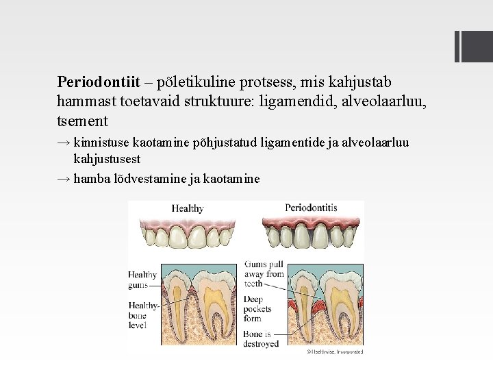 Periodontiit – põletikuline protsess, mis kahjustab hammast toetavaid struktuure: ligamendid, alveolaarluu, tsement → kinnistuse