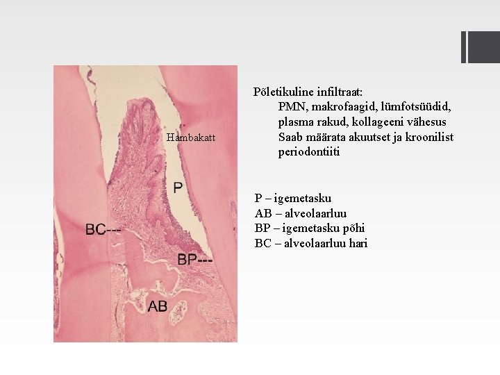 Hambakatt Põletikuline infiltraat: PMN, makrofaagid, lümfotsüüdid, plasma rakud, kollageeni vähesus Saab määrata akuutset ja