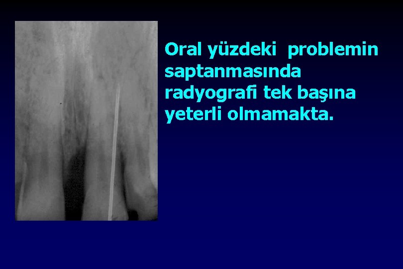 Oral yüzdeki problemin saptanmasında radyografi tek başına yeterli olmamakta. 