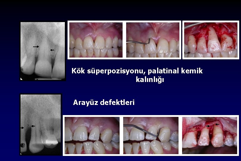 Kök süperpozisyonu, palatinal kemik kalınlığı Arayüz defektleri 