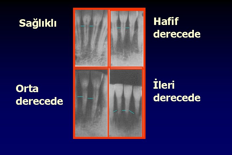 Sağlıklı Hafif derecede Orta derecede İleri derecede 