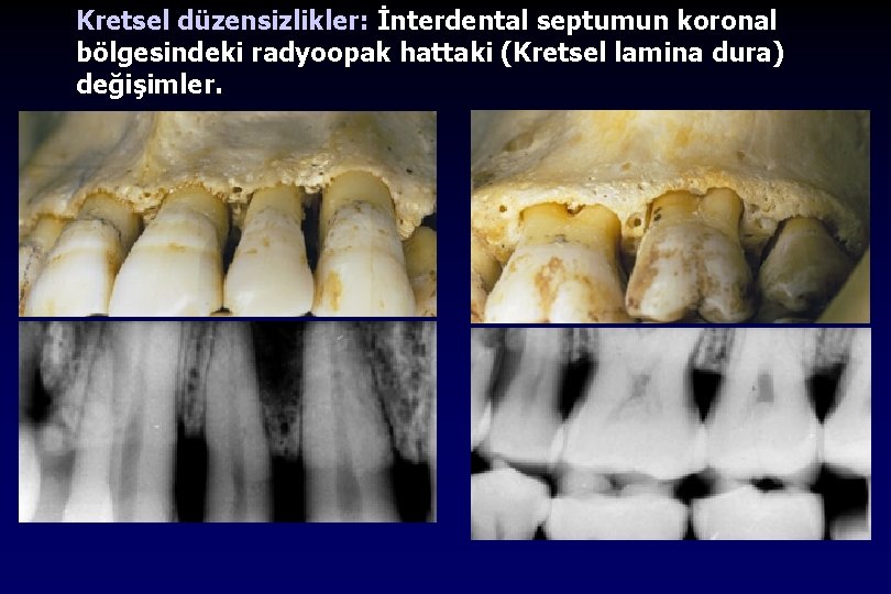 Kretsel düzensizlikler: İnterdental septumun koronal bölgesindeki radyoopak hattaki (Kretsel lamina dura) değişimler. 