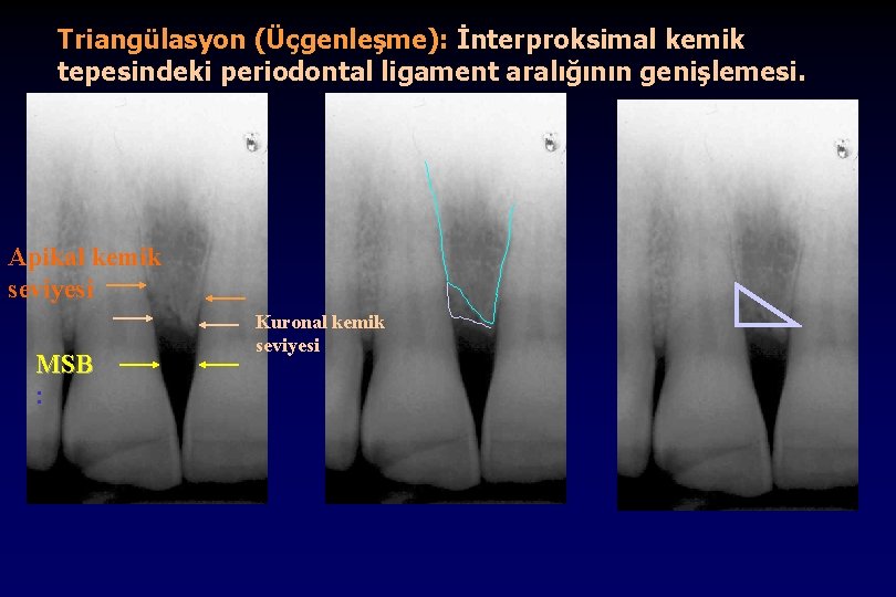 Triangülasyon (Üçgenleşme): İnterproksimal kemik tepesindeki periodontal ligament aralığının genişlemesi. Apikal kemik seviyesi MSB :