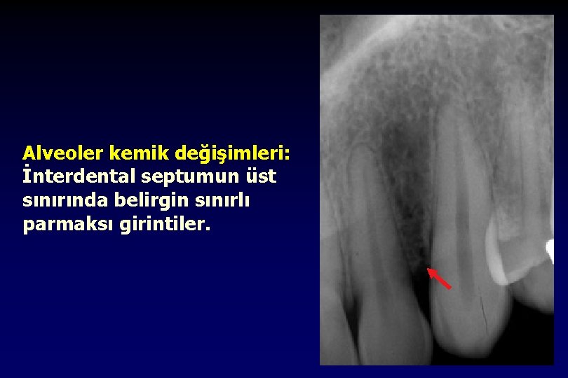 Alveoler kemik değişimleri: İnterdental septumun üst sınırında belirgin sınırlı parmaksı girintiler. 