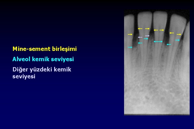 Mine-sement birleşimi Alveol kemik seviyesi Diğer yüzdeki kemik seviyesi 