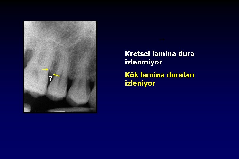 Kretsel lamina dura izlenmiyor ? Kök lamina duraları izleniyor 