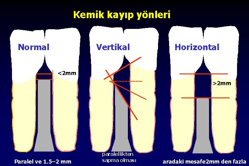 Kemik kayıp yönleri Normal Vertikal Horizontal <2 mm >2 mm Paralel ve 1. 5–