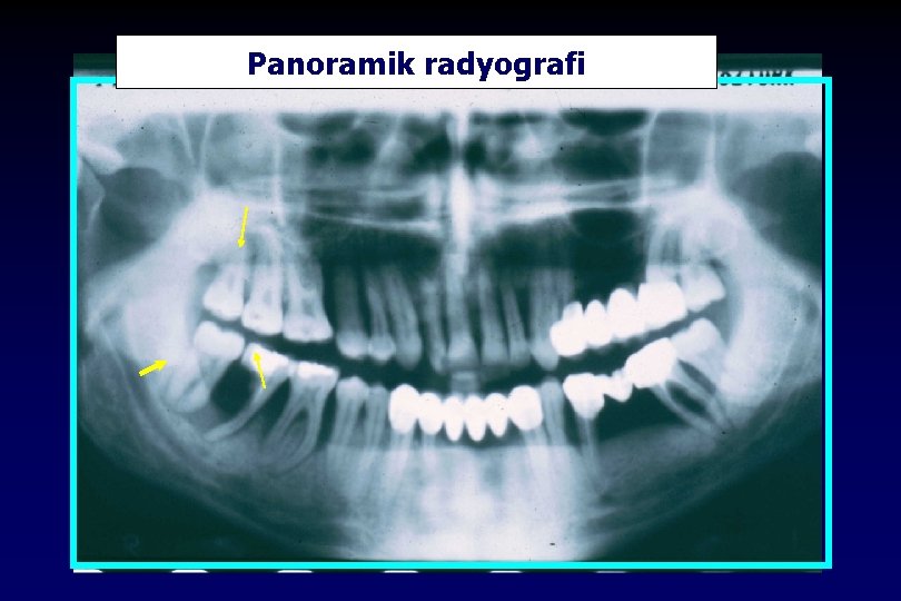 Panoramik radyografi 