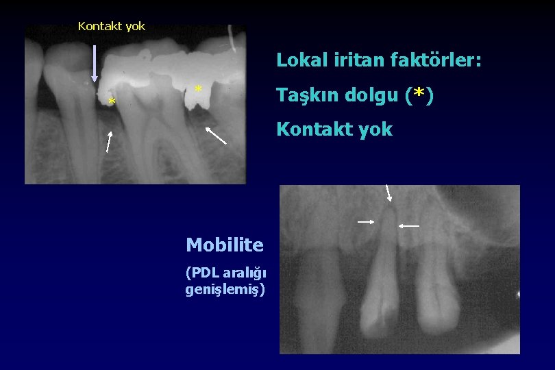 Kontakt yok Lokal iritan faktörler: * * Taşkın dolgu (*) Kontakt yok Mobilite (PDL