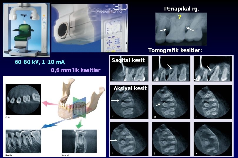 Periapikal rg. ? Tomografik kesitler: 60 -80 k. V, 1 -10 m. A Sagital