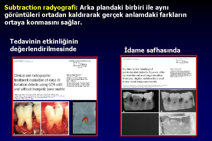 Subtraction radyografi: Arka plandaki birbiri ile aynı görüntüleri ortadan kaldırarak gerçek anlamdaki farkların ortaya