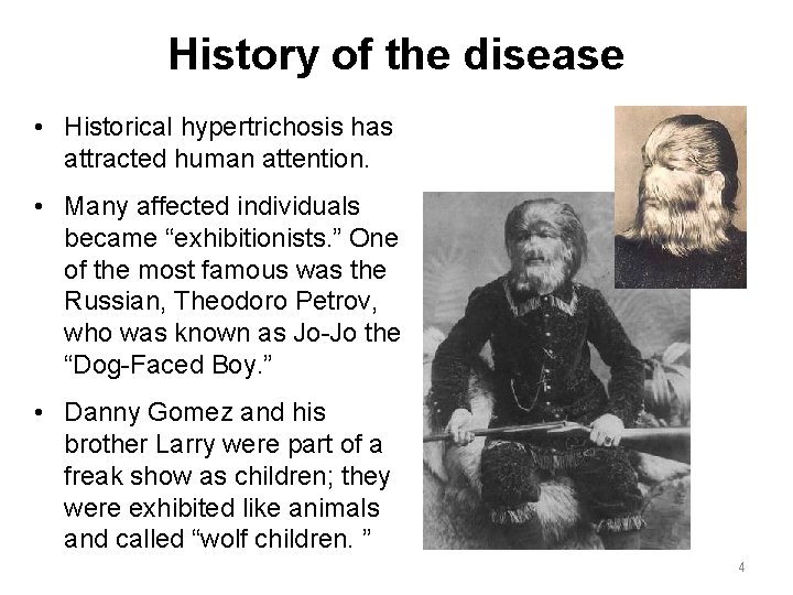 History of the disease • Historical hypertrichosis has attracted human attention. • Many affected